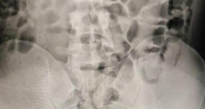 Homem passa por raio-x no estômago e exame revela crime em SC.