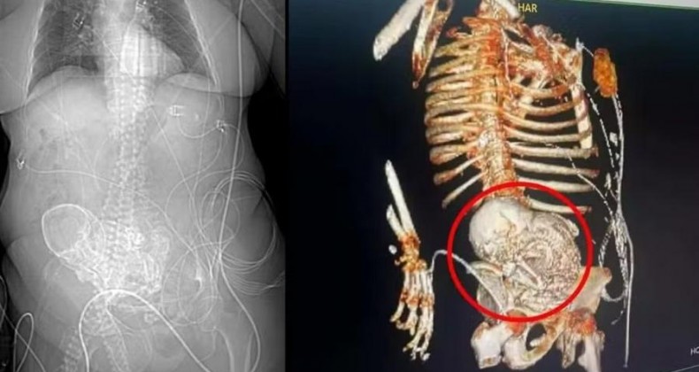 Idosa descobre feto calcificado que carregou por 56 anos.